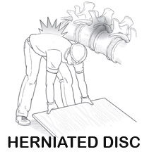 Herniated disc injury can occur lifting sheet from floor